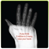 2Million2Many campaign flags bone fracture, osteoporosis link