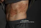 Merck campaign shows impact of shingles Merck campaign shows impact of shingles